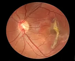 Retinal Examination